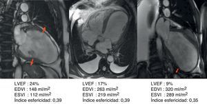 Proceso de remodelado del ventrículo izquierdo tras el infarto de miocardio. Puede apreciarse en estos 3 ejemplos de resonancia magnética que inclusive la dilatación ventricular en el proceso del remodelado mantiene una forma más elíptica que esférica.