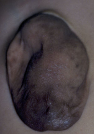 Ectopia cordis, vista frontal.
