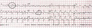 ECG: signos electrocardiográficos compatibles con lesión de tronco coronario izquierdo.