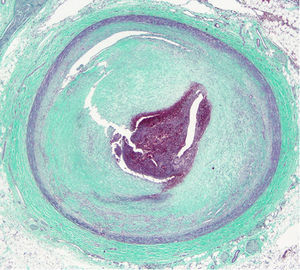 Arteria descendente anterior: tricrómico de Masson. Trombosis, con oclusión del 100% de la luz. Resaltan la hiperplasia fibrointimal y la organización de la fibrina.