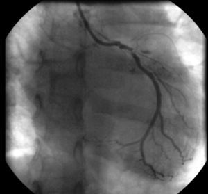 Cateterismo coronario izquierdo: TCI de escaso calibre con imagen obstructiva en el tercio medio. Arteria descendente anterior con oclusión trombótica aguda a nivel ostial proximal y arteria circunfleja con lesión ostial crítica desde el tronco de la coronaria izquierda.