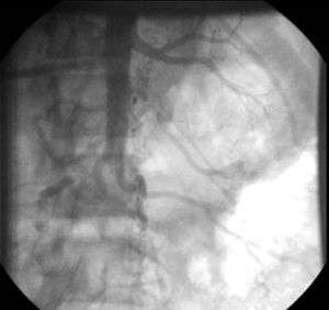 Aortografía: interrupción aórtica en la salida de las arterias renales, así como de la bifurcación iliaca. Abundante circulación colateral.