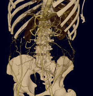 TC con reconstrucción tridimensional: interrupción aórtica en la salida de las arterias renales, así como de la bifurcación iliaca. Las arterias femorales comunes se repermeabilizan a través de la importante circulación colateral en la pared abdominal y de las arterias pélvicas.