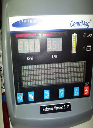 Asistencia ventricular izquierda: asistencia Levitronix® CentriMag; flujo 3,5 l/min.