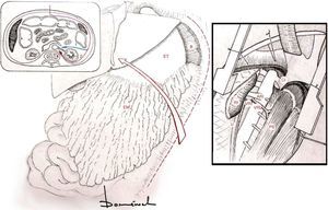 Rotación visceral medial izquierda. ARI: arteria renal izquierda; B: bazo; CI: crus diafragmática izquierda; EM: epiplón mayor; ET: estómago; PS: músculo psoas; RI: riñón izquierdo; U: uréter izquierdo; VRI: vena renal izquierda; VRL: vena reno-lumbar; 1: vía prerrenal; 2: vía retrorrenal.