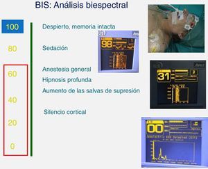 Monitorización de índice biespectral-profundidad anestésica.