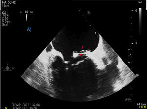 Imagen de ecocardiografía transtorácica 2D en la que se aprecia dehiscencia de la prótesis a nivel posterior del anillo mitral (flecha).