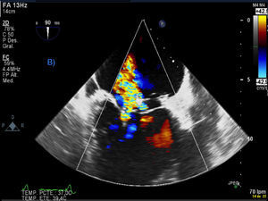 Imagen de ecocardiografía transesofágica Doppler color; se observa regurgitación periprotésica severa.