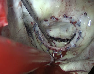 Imagen de ecocardiografía transtorácica 3D, en la que se observa dehiscencia de la prótesis a nivel posterior de la anuloplastia mitral.