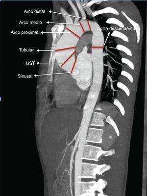 Lugar de las mediciones en la aorta ascendente.