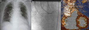 a) La radiografía de tórax pone en evidencia la aorta de porcelana. b) En el estudio coronariográfico se observa la aorta severamente calcificada. c) Tomografía multicorte contrastada que muestra severa calcificación de la aorta ascendente.