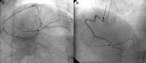 a) Lesión crítica del tronco de la arteria coronaria izquierda que involucra el origen de la ADA y de la arteria circunfleja. b) Lesión crítica de la ACD en su origen y de su ramo posterolateral.