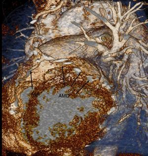 Tomografía multicorte contrastada donde se observa la permeabilidad de ambas arterias mamarias y la aorta de porcelana.