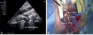 A) Imagen ecocardiográfica preoperatoria. Se identifican carótida izquierda, arco aórtico distal, subclavia izquierda, istmo, ductus y aorta descendente. B) Imagen quirúrgica. Se han disecado y liberado carótida izquierda, arco aórtico distal, subclavia izquierda, istmo, ductus y aorta descendente. Se encuentran referidas con vessel-loops las arterias carótida y subclavia izquierdas.