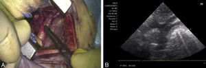 A) Imagen quirúrgica. Final. B) Imagen ecocardiográfica postoperatoria.