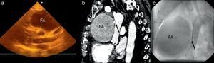 a) La imagen ecocardiográfica (vista paraesternal) pone de manifiesto la presencia de un gran falso aneurisma a nivel de la aorta ascendente; b) La TC multicorte contrastada confirma el diagnóstico clínico-ecocardiográfico. La flecha negra muestra el sitio de entrada al falso aneurisma; c) La angiografía de la aorta ascendente también pone de manifiesto el falso aneurisma y su cercanía a la pared esternal (ver flecha blanca). La flecha negra muestra el orificio de entrada.