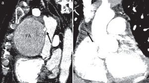 a) Imagen preoperatoria del falso aneurisma y la compresión y deformación que provocaba sobre la aorta ascendente; b) Imagen 4 años después, que muestra una aorta ascendente normal y sin recidiva del falso aneurisma (la flecha negra muestra tejido fibroso periaórtico).
