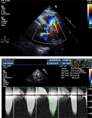 Arriba doppler color y abajo doppler continúo con gradientes.