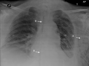 Radiografía de tórax en proyección postero-anterior que muestra enfisema subcutáneo (flecha A) y línea de dehiscencia de sutura esternal (flecha B).