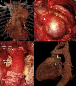 Modelo aorto-aórtico realizado en 4 pacientes. A) ATC preoperatoria. B) Hallazgo de AAoD intraoperatorio (punta de flecha: nervio laríngeo recurrente). C) Resultado final intraoperatorio. D) ATC postoperatoria.