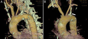 A y B) Angio-TC (reconstrucción 3D): placa de ateroma calcificada en el origen de la arteria subclavia izquierda (flechas).