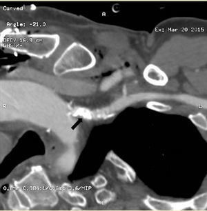 Angio-TC (reformateo curvo): placa de ateroma calcificada en el origen de la arteria subclavia izquierda (flecha).