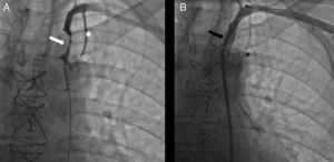 Angiografía: A) Estenosis crítica en origen de la arteria subclavia izquierda (flecha blanca), AMII con flujo invertido (asterisco blanco); B) Stent Assurant Cobalt® 9/30mm (flecha negra), AMII con flujo normalizado (asterisco negro).