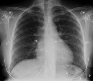 Radiografía de tórax al ingreso: sin datos patológicos relevantes. Ausencia de signos de congestión pulmonar.
