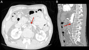 Imágenes axial y sagital de angioTAC abdominopélvico que muestran una trombosis extensa en aorta abdominal, con oclusión completa de la misma a nivel infrarrenal (flecha roja).