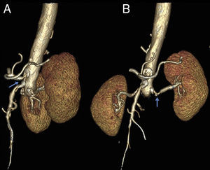 Reconstricción tridimensional que muestra oclusión completa de aorta infrarrenal y estenosis significativa del origen del tronco celiaco, arteria mesentérica superior, arteria renal derecha y renal izquierda (flecha azul).