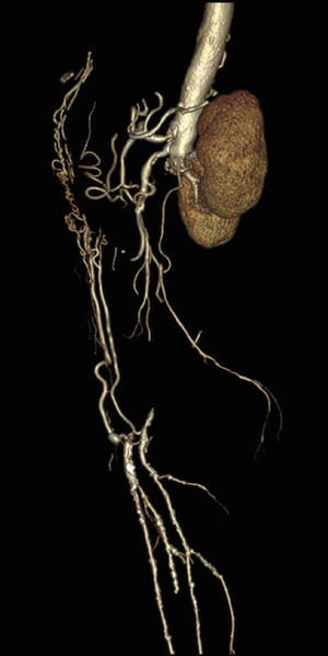 Reconstrucción tridimensional que muestra la oclusión completa de aorta abdominal infrarrenal y el desarrollo de circulación colateral de las arterias epigástricas, asegurando la perfusión de los miembros inferiores.