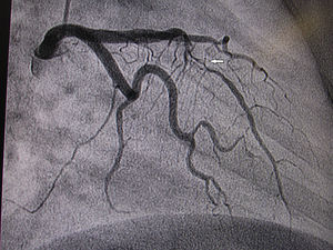 Coronariografía mostrando disección en la arteria descendente anterior (caso 4).