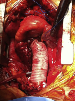 Sustitución de aorta ascendente y raíz aórtica con conducto valvulado.