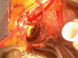Imagen del campo quirúrgico que muestra un hematoma intramural de aorta ascendente con canulación selectiva de los troncos supraaórticos.