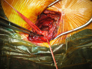 Disección de la arteria subclavia izquierda.