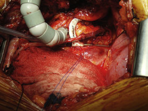 Anastomosis de la mamaria derecha-safena-descendente posterior.