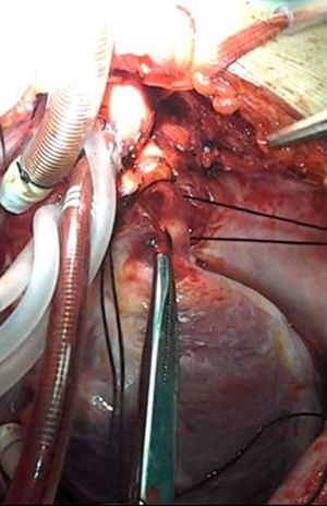 Conducto arteriovenoso con reparo vascular.