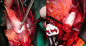 Fontan intra-extracardíaco en VU izquierdo doble entrada+LTGA+doble lesión válvula AV izquierda. A) Sutura del conducto de PTFE que, recogiendo el flujo de la cava inferior, se hace extracardíaco. B) Sutura del conducto al tronco pulmonar previamente seccionado para completar el Fontan.