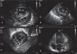 A) Paraesternal eje corto prequirúrgico. Aumento de presión en el VD. Tabique interventricular tipo iii. B) Paraesternal eje largo prequirúrgico. VI colapsado. C) Subcostal corto posquirúrgico. Morfología normal del VI. D) Apical 4 cámaras posquirúrgico con disfunción VI severa.VD: ventrículo derecho; VI: ventrículo izquierdo.