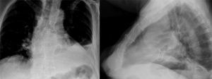 Radiografía de tórax donde se puede apreciar la sutura tipo Robiseck.