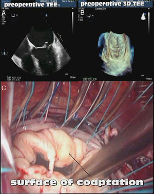 Evaluación de la válvula mitral con ecocardiografía tridimensional. A) Ecocardiografía transesofágica preoperatoria (plano a 0°) ilustrando la dilatación de la aurícula izquierda y la configuración valvular mitral (rotura de cuerda en velo anterior). B) Ecocardiografía tridimensional (visión desde aurícula izquierda) que demuestra la imagen de cuerda rota en el velo anterior. C) Imagen quirúrgica que confirma la rotura de cuerda en el velo anterior.