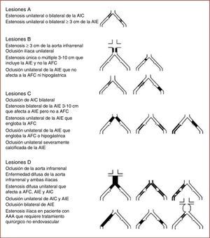 Clasificación TASC II de las lesiones oclusivas arterioscleróticas del sector fémoro-poplíteo-distal. Tomado de: Norgren et al.8.