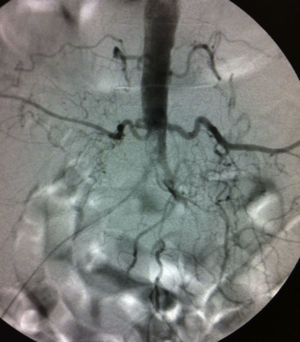 Arteriografía diagnóstica de paciente con obstrucción término-aórtica y de ambos ejes ilíacos.