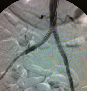 Resultado tras tratamiento intravascular.