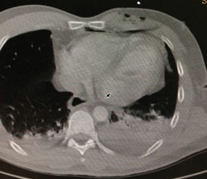 Hemotórax izquierdo de importante cuantía.