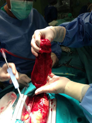 Coágulo de gran tamaño localizado sobre la zona perforada.