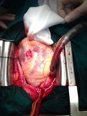 Incisiones ocasionadas sobre el territorio de descendente anterior.