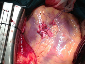 Sutura de las incisiones.