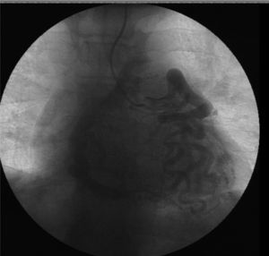 Cinecoronariografia donde se observa el origen aberrante de la arteria coronaria derecha.