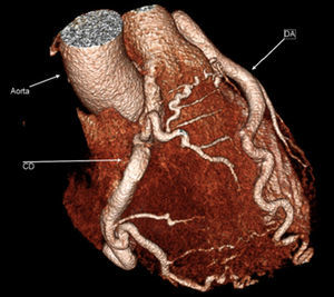 TC con reconstrucción 3D en la que se observa el origen anómalo de la arteria coronaria derecha.